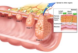 Esophageal-Cancer