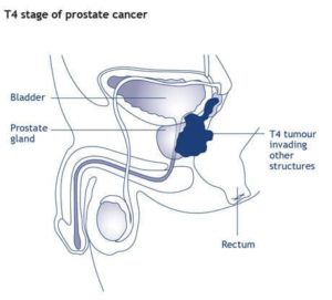 Prostate-Cancer