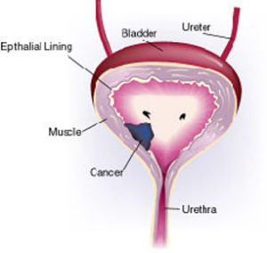 bladder-cancer