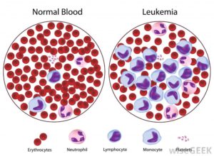 blood cancer