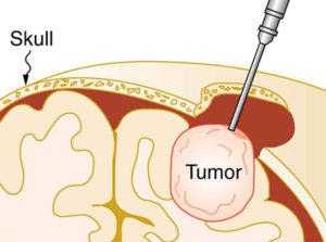 brain cancer