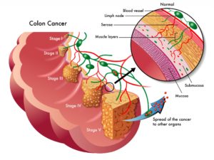 colon-cancer