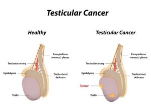 diagram-of-testicular-cancer