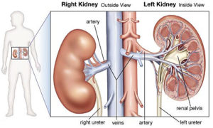 kidney cancer