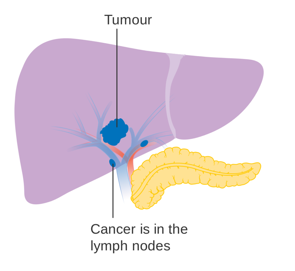 आयुर्वेद में है लीवर रोग की चिकित्सा Liver Cancer 1024x942