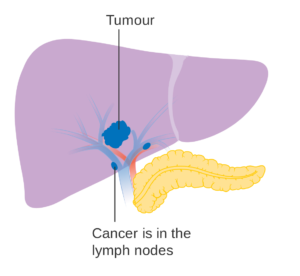 liver cancer