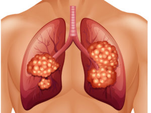 lung cancer