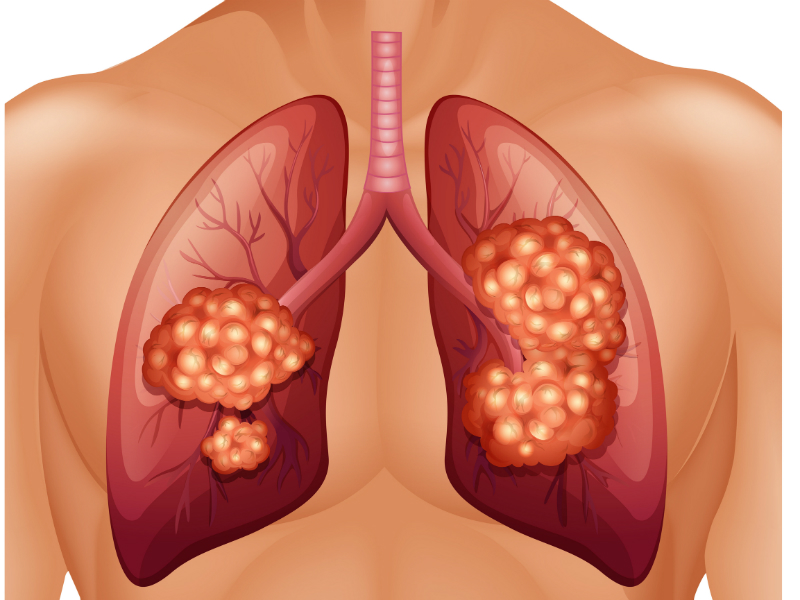 आखिर क्यों होता है कैंसर ! Lung Cancer