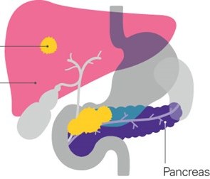 pancreatic cancar