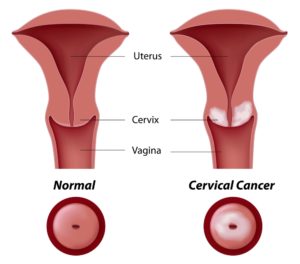 uterine