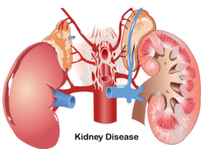 Best Ayurvedic Hospital For Kidney Treatment