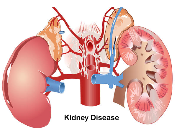 बिगड़ा क्रिएटनीन लेवल आजमाएं नीम और पीपल Kidney Disease