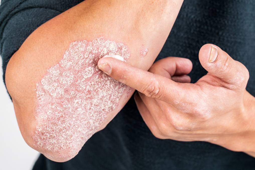 सर्दियों में त्वचा की देखभाल, चमकता रहेगा चेहरा Psoriasis