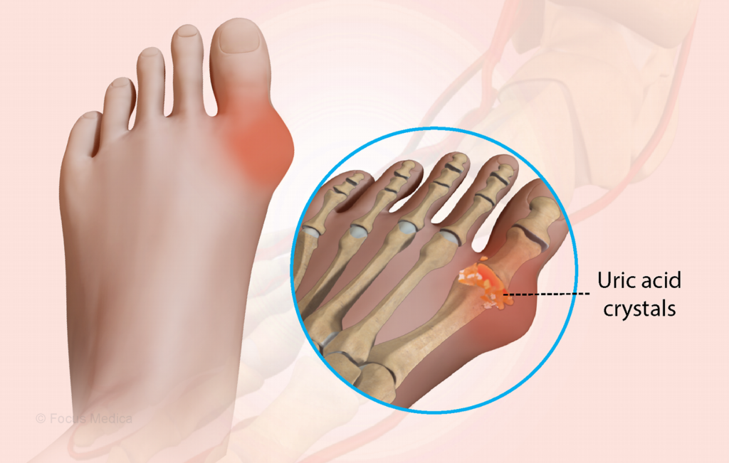 यूरिक एसिड का बढ़ने से परेशान, बस 05 में असर Uric 1024x651